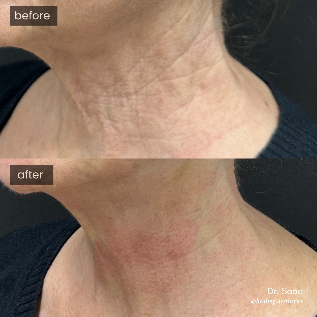 Before and after Neck ReDefine — lined, crepey neck tightened and smoothed, actual patient of Dr. Saad