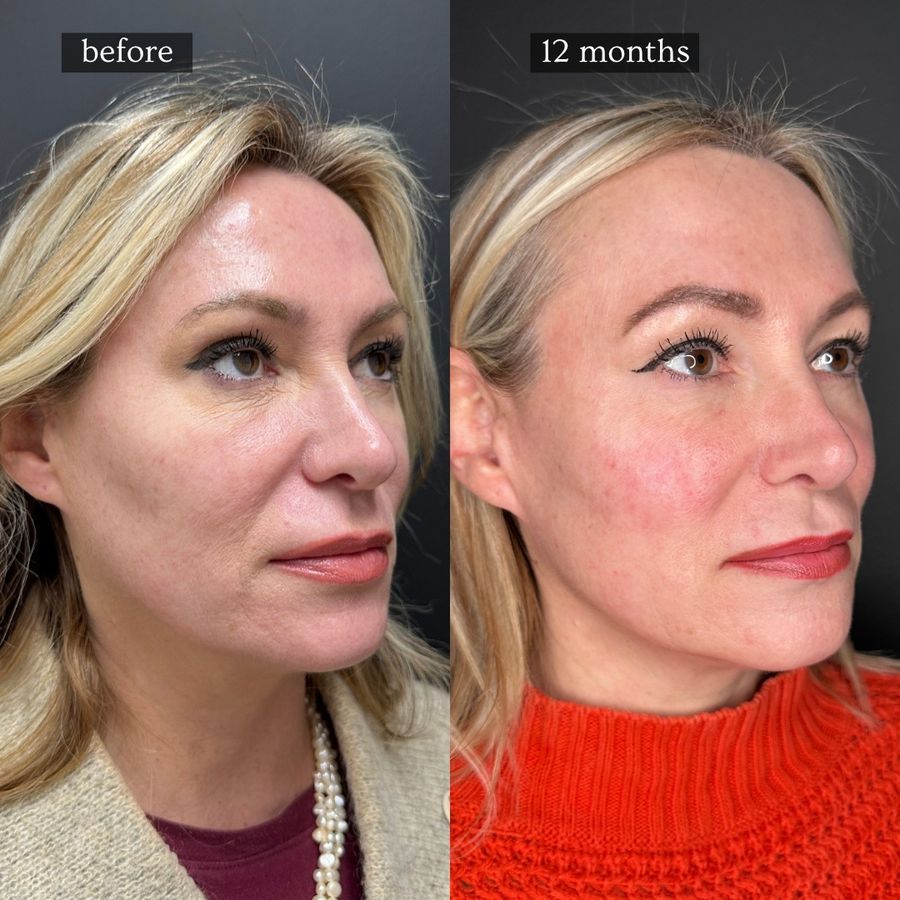 Before and 12 months after Sculptra: fuller, lifted cheeks and a refreshed facial contour