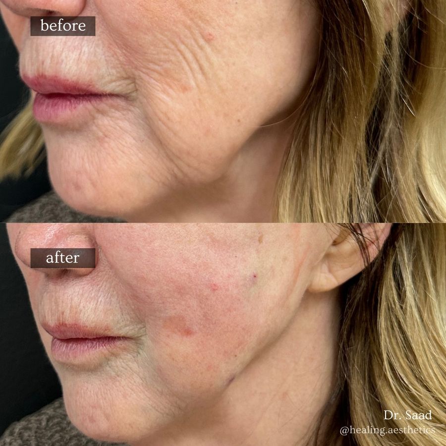 Before and after Sculptra: smoother, firmer skin across the cheek and lower face
