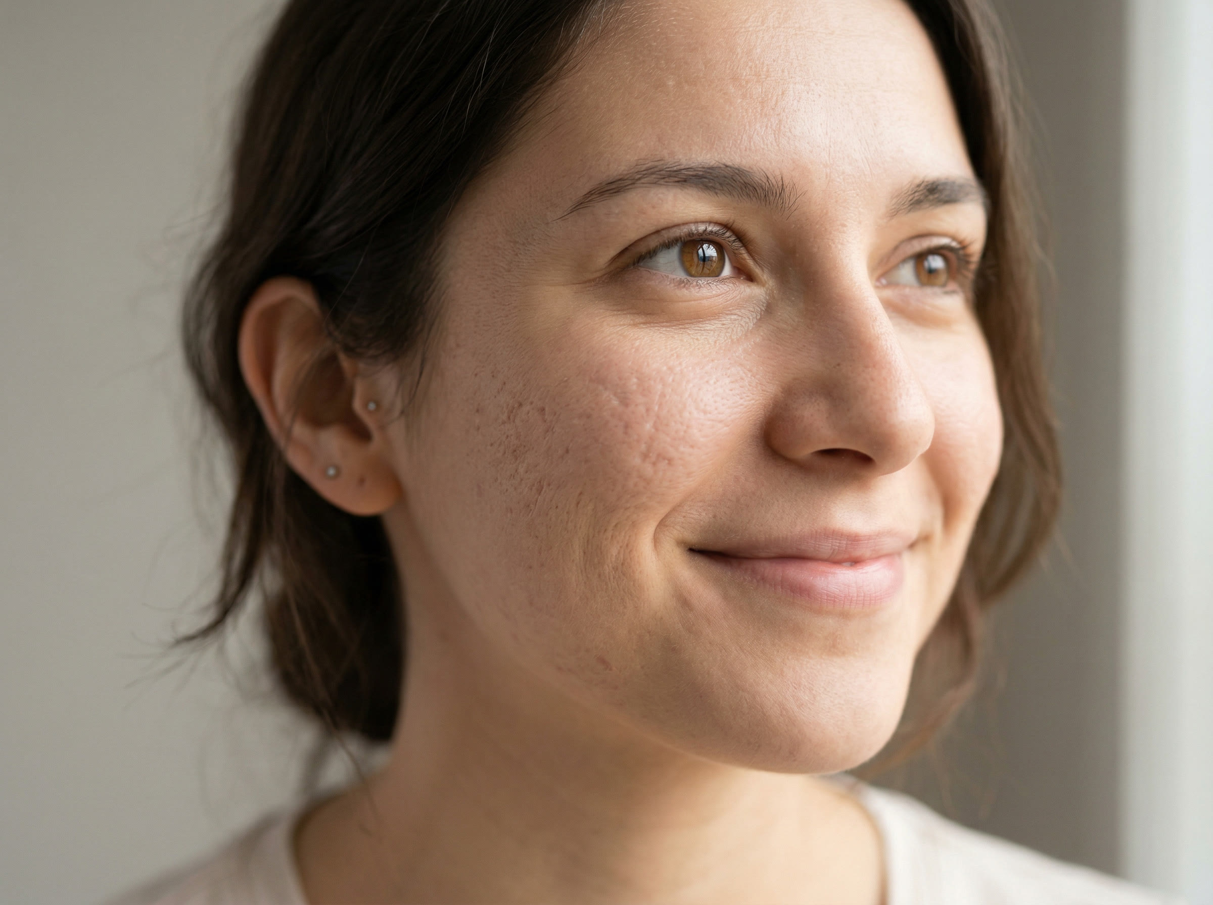 Acne and acne scar treatment at Healing Aesthetics in Hinsdale, IL