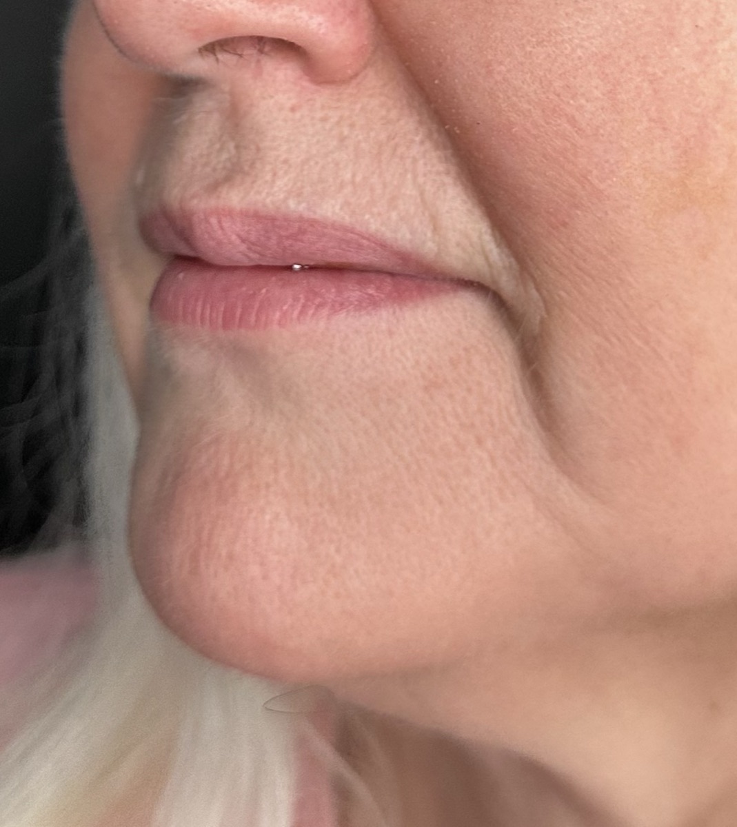 Side view of a patient's lower face with the marionette line marked — the crease running from the corner of the mouth toward the chin