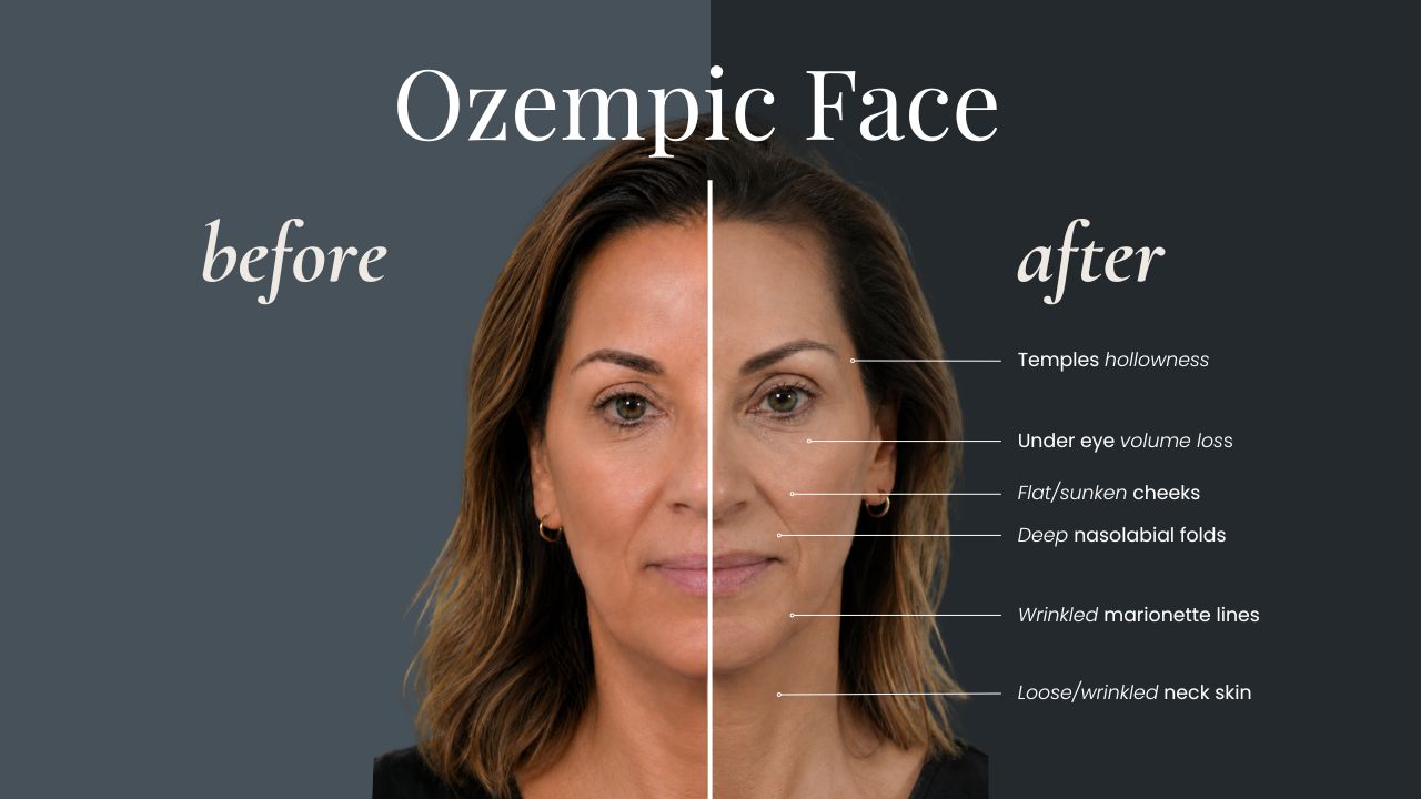 The same woman shown before and after rapid weight loss, with Ozempic face changes labeled: temple hollowness, under-eye volume loss, flat or sunken cheeks, deep nasolabial folds, wrinkled marionette lines, and loose, wrinkled neck skin