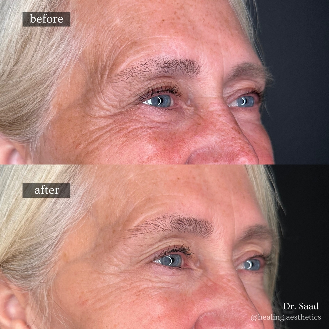 Botox before and after — Crow's Feet & Upper Eye Rejuvenation, real Hinsdale patient