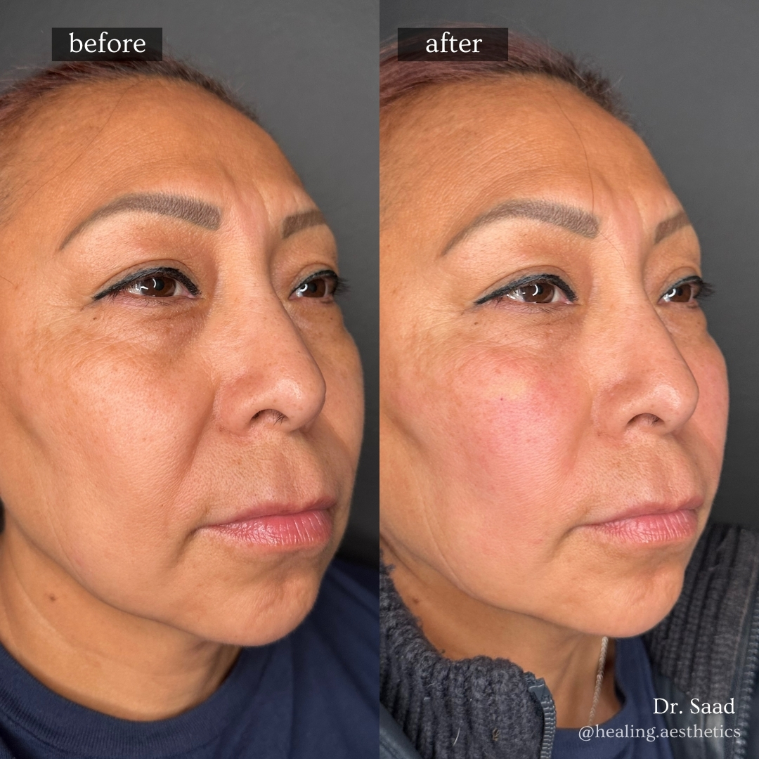 Before and after midface volume and cheek contour restoration with dermal filler