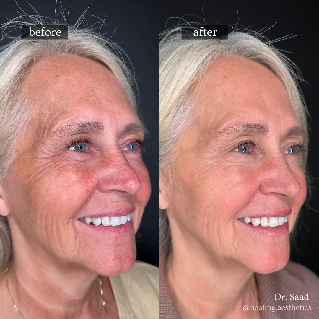 Before and after full-face rejuvenation and skin brightening with Sculptra