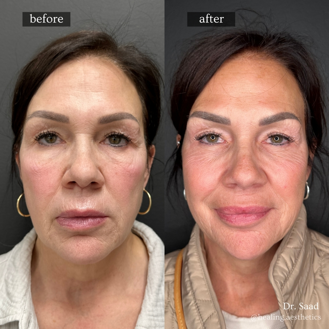 Before and after results from Dr. Saad's anti-aging treatment protocol