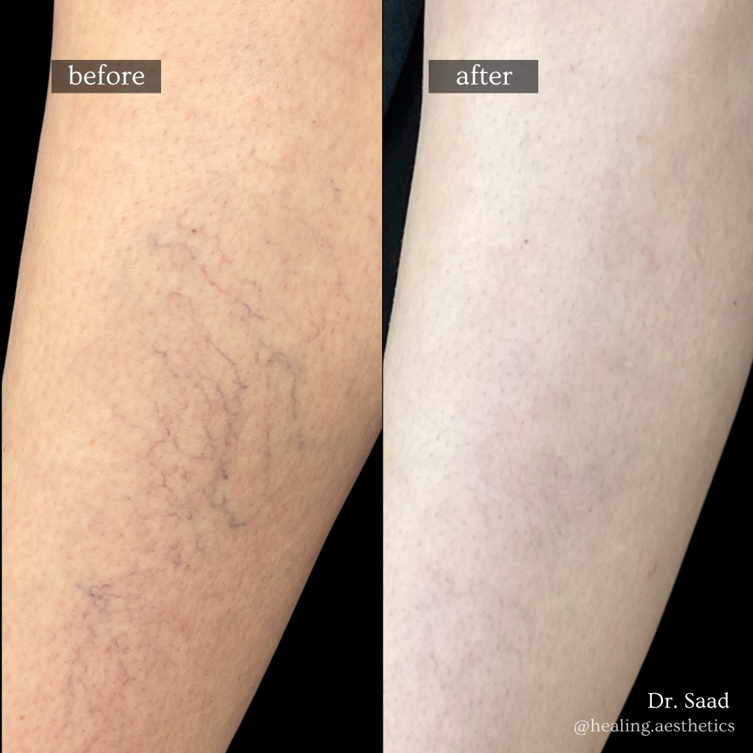 Before and after spider vein removal on legs