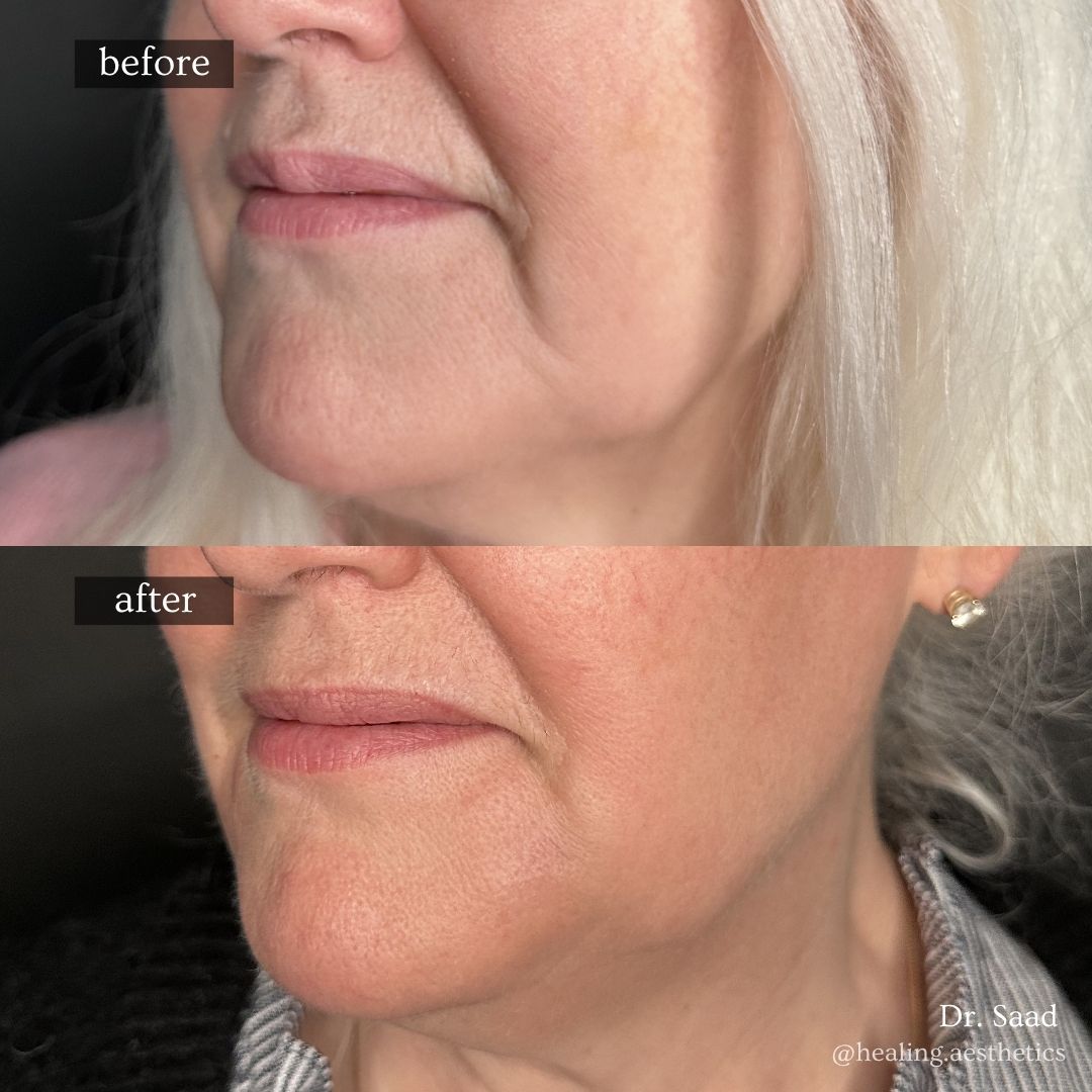 Before and after — Radiesse treatment for marionette lines at Healing Aesthetics, Hinsdale IL