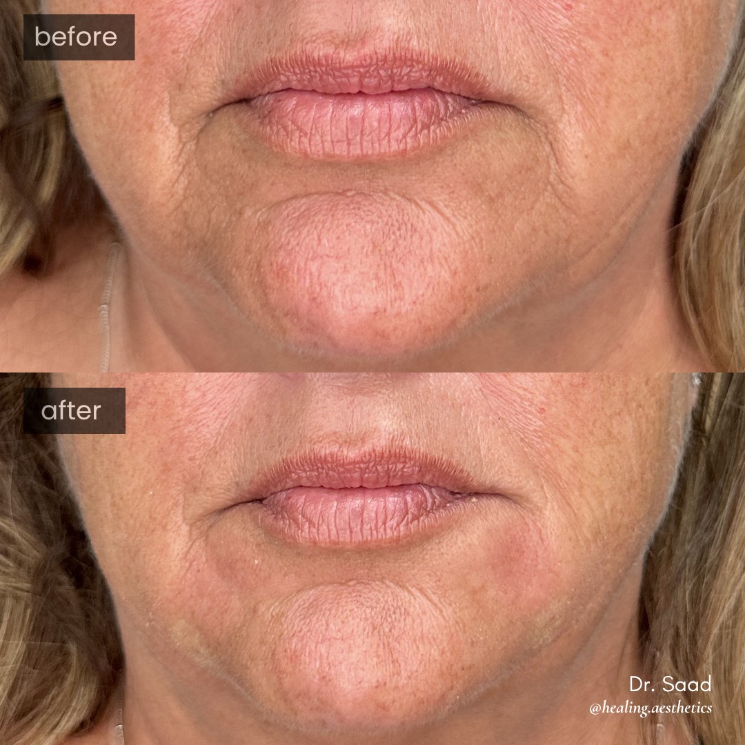 Before and after marionette lines treatment with Radiesse — softened mouth corner lines, front view