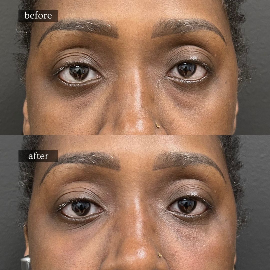 Before and after under-eye dark circle and hollow correction at Healing Aesthetics