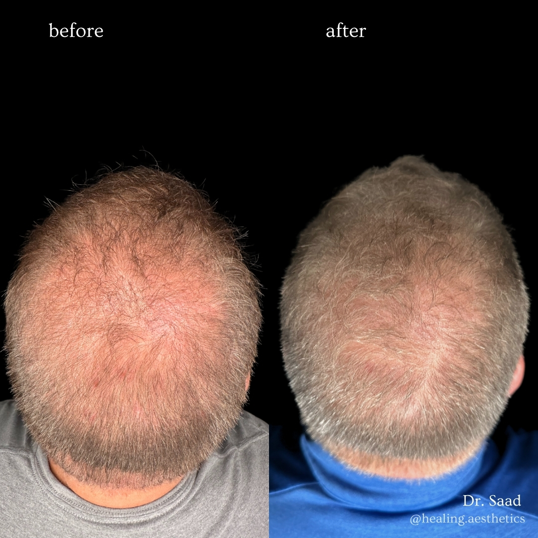 PRF hair restoration before and after at Healing Aesthetics Hinsdale IL