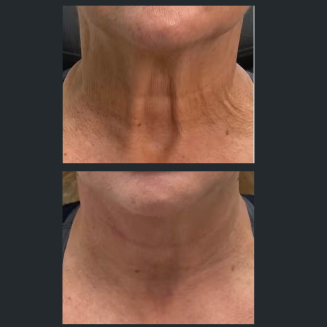 Before and after Botox treatment of platysmal neck bands