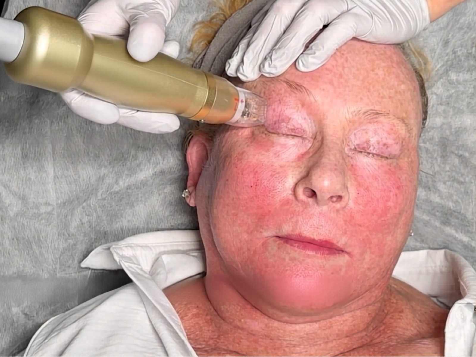 Sylfirm X Radiofrequency Microneedling at Healing Aesthetics